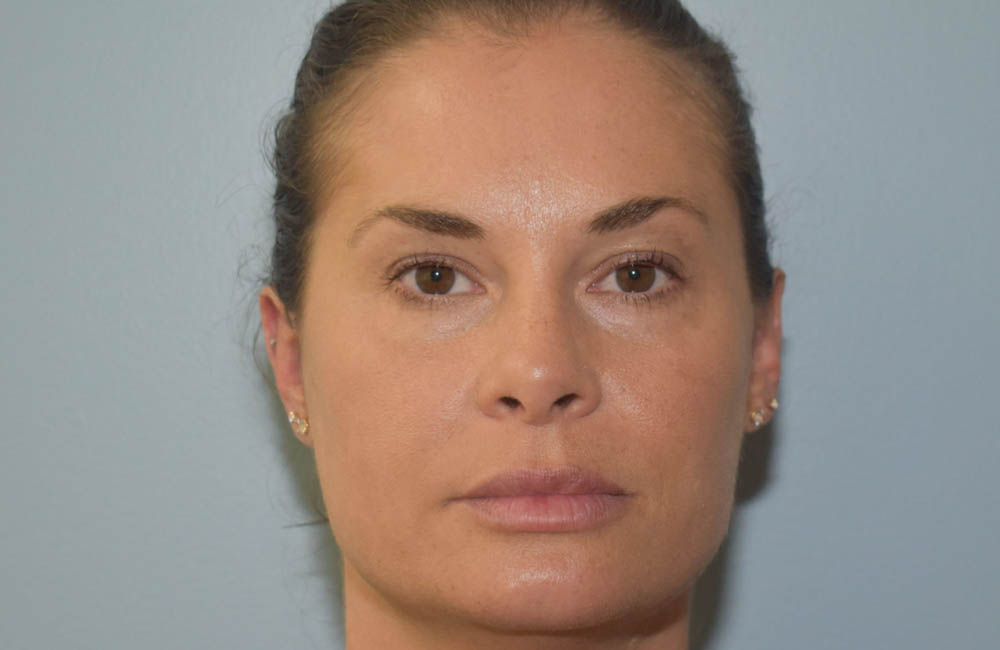 Fillers case #4360