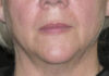 Thermage case #3574