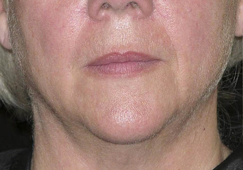 Thermage case #3574