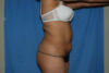 Mommy Makeover case #5638