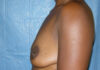 Breast Augmentation case #3909