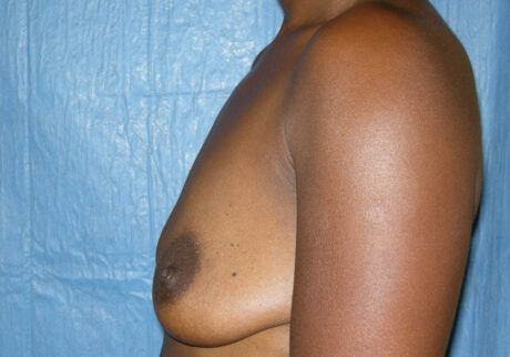 Breast Augmentation case #3909