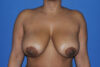 Breast Reduction case #4034