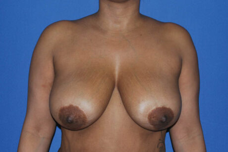 Breast Reduction case #4034