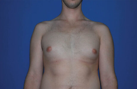 Male Breast Reduction case #4859