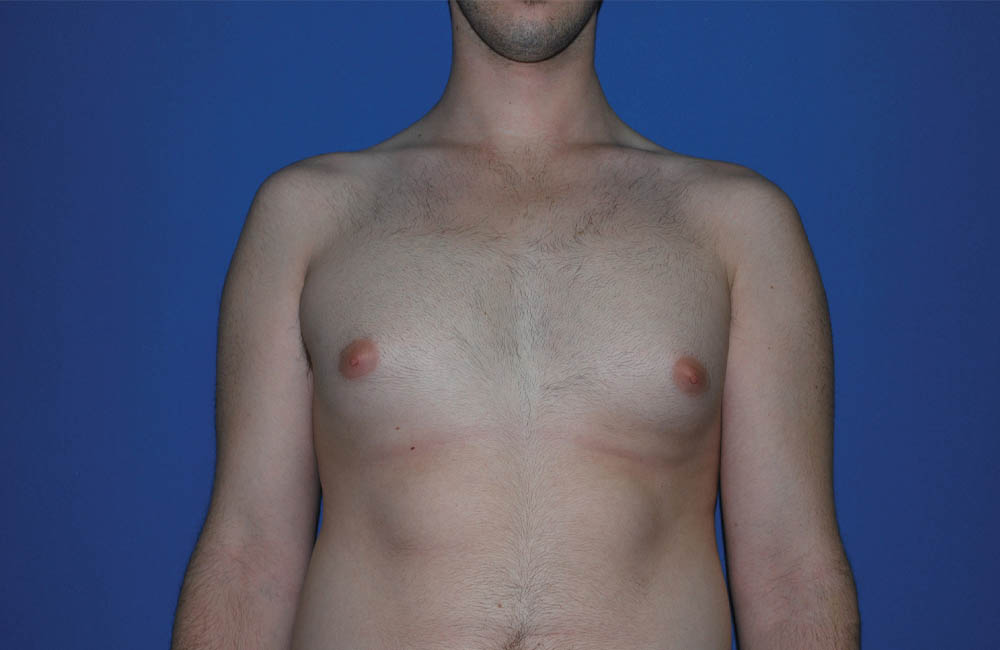 Male Breast Reduction case #4859