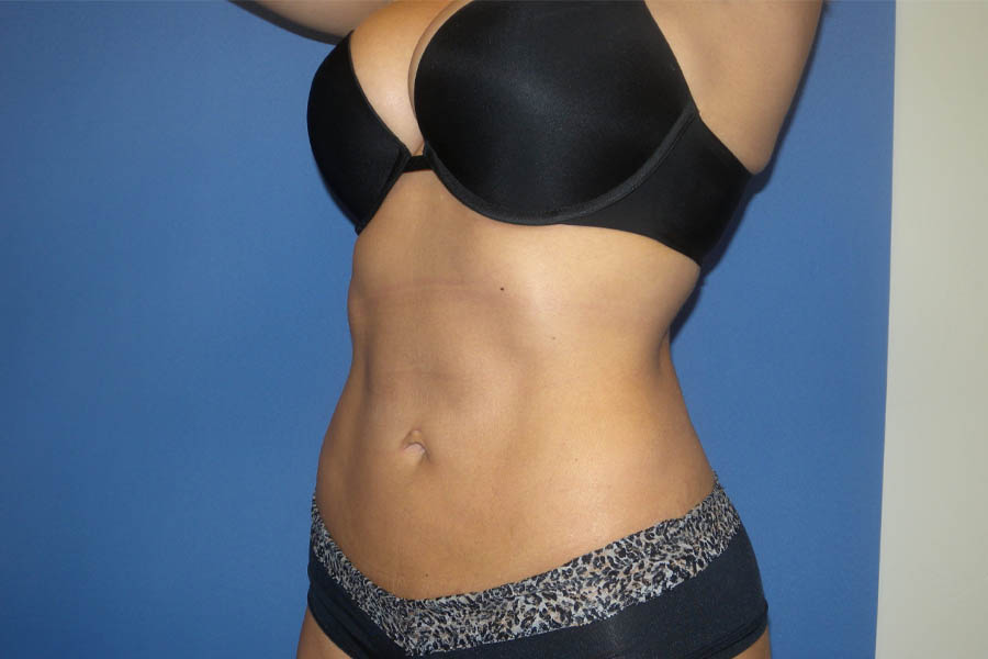 Liposuction case #4514