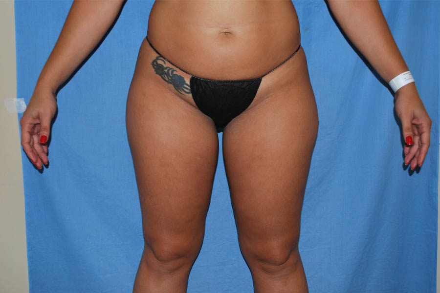 Liposuction case #4514