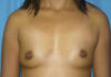 Breast Augmentation case #3914