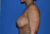 Breast Reduction case #4034