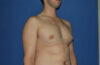 Male Breast Reduction case #4859