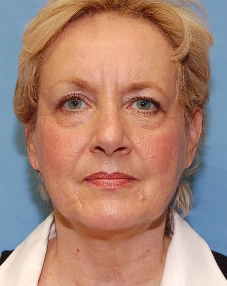 Forehead Lift case #4384