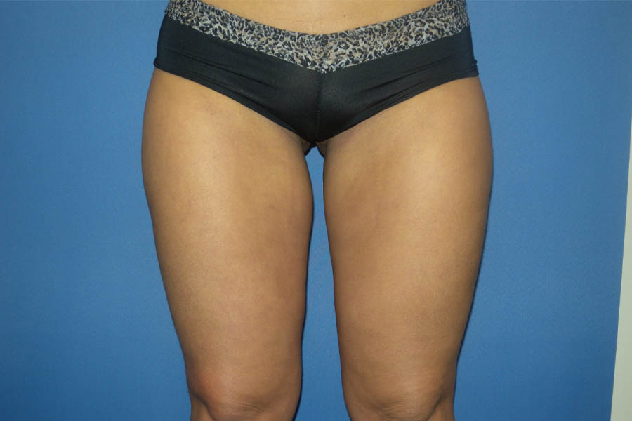 Liposuction case #4514