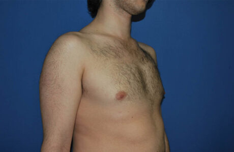 Male Breast Reduction case #4859