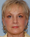 Forehead Lift case #4384