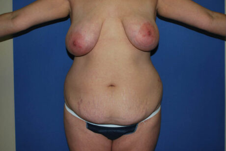 Mommy Makeover case #5627