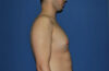 Male Breast Reduction case #4859