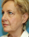 Forehead Lift case #4384