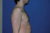 Male Breast Reduction case #4859