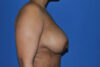 Breast Reduction case #4034