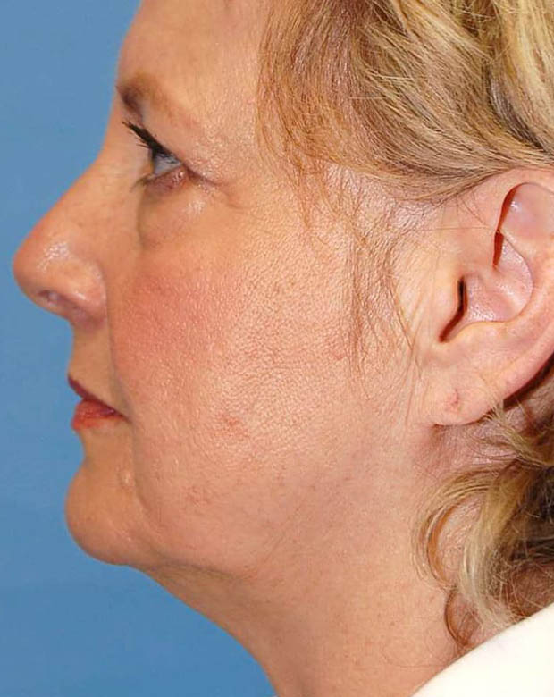 Forehead Lift case #4384