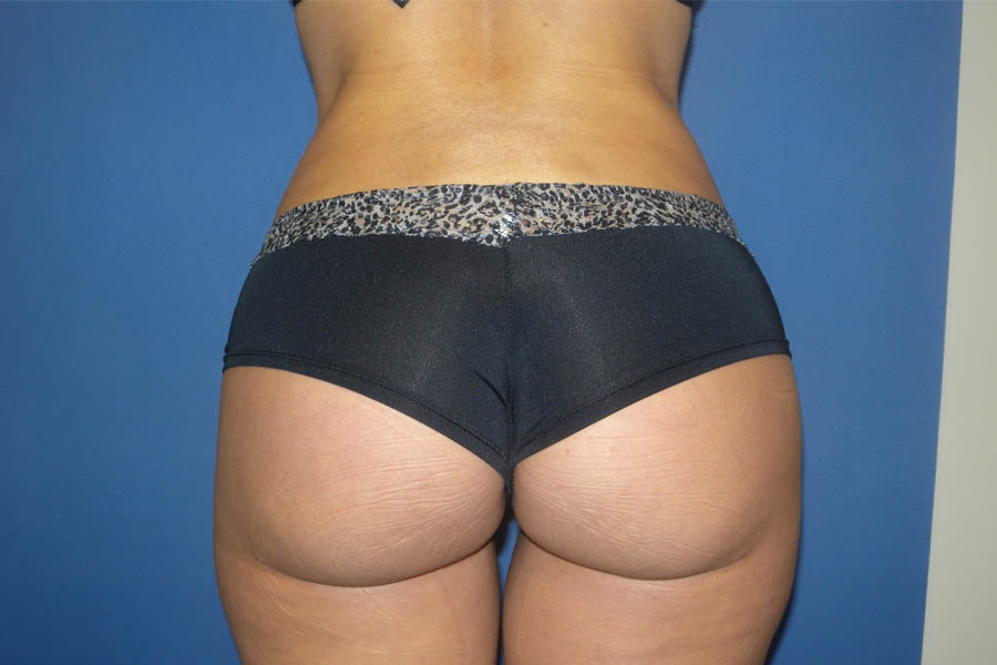 Liposuction case #4514