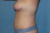 Mommy Makeover case #5627