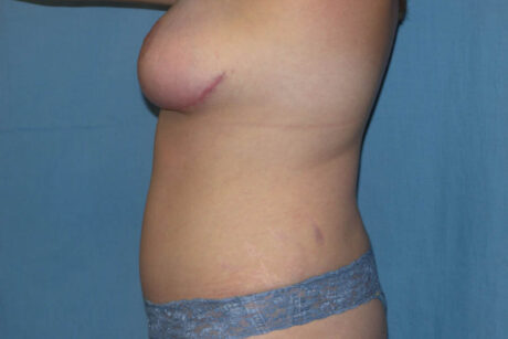 Mommy Makeover case #5627