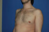 Male Breast Reduction case #4859