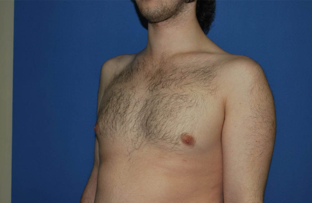 Male Breast Reduction case #4859