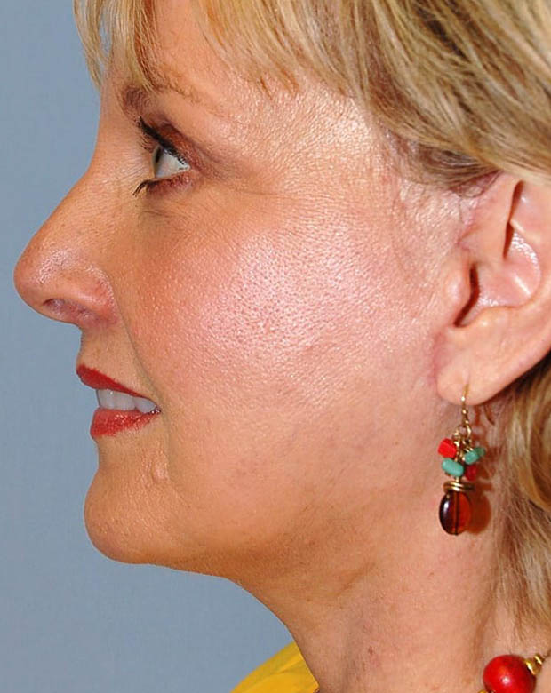 Forehead Lift case #4384