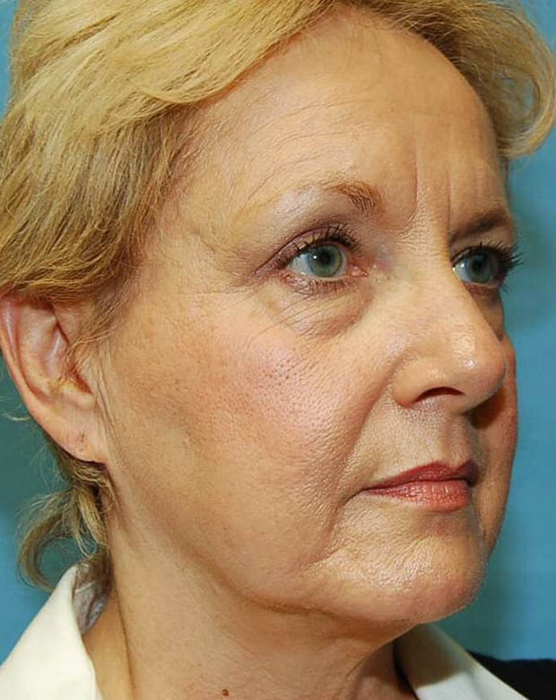 Forehead Lift case #4384