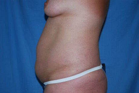 Liposuction case #4525