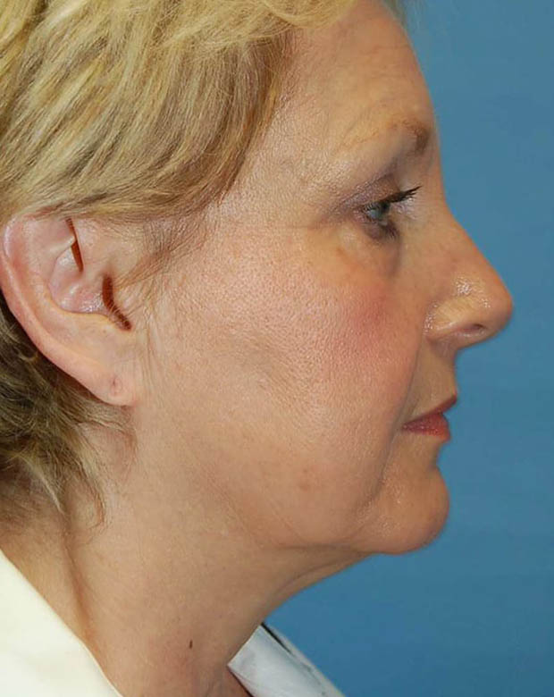 Forehead Lift case #4384