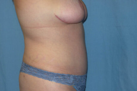 Mommy Makeover case #5627