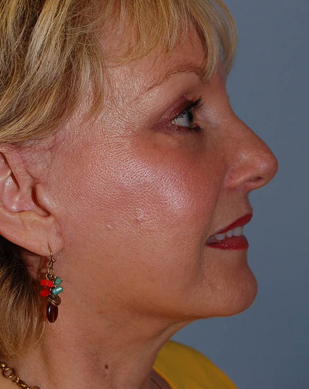 Forehead Lift case #4384