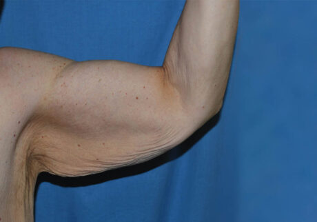 Arm Lift case #3718