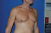 Male Breast Reduction case #4870