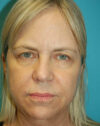 Forehead Lift case #4395