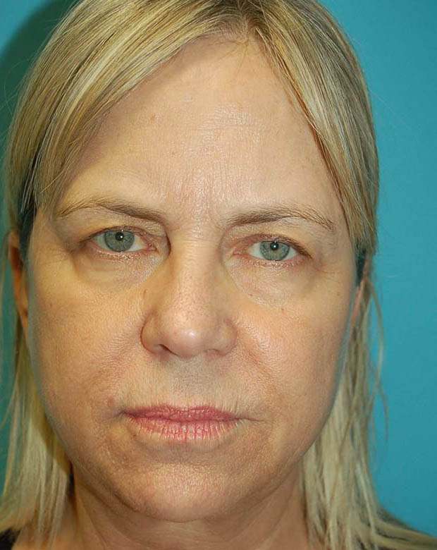 Forehead Lift case #4395