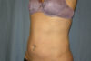Liposuction case #4525