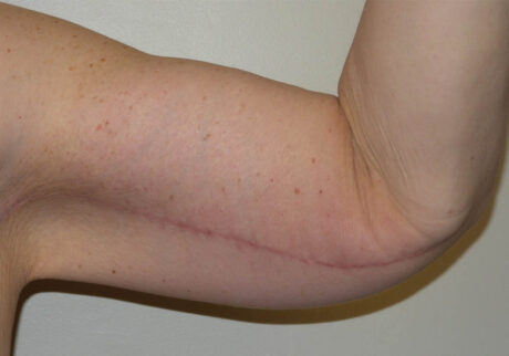 Arm Lift case #3718