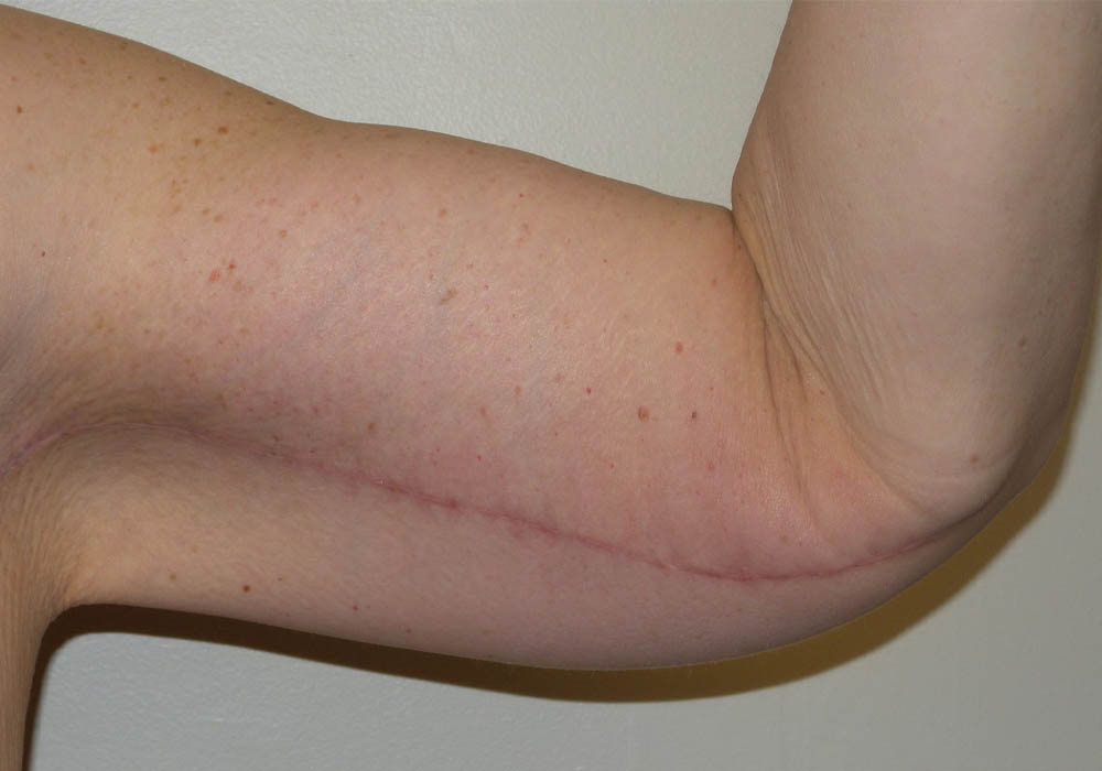 Arm Lift case #3718