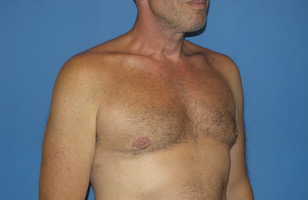 Male Breast Reduction case #4870