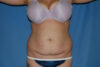 Mommy Makeover case #5616