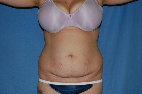 Mommy Makeover case #5616
