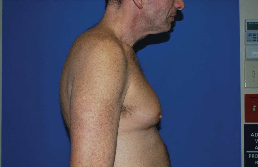 Male Breast Reduction case #4870