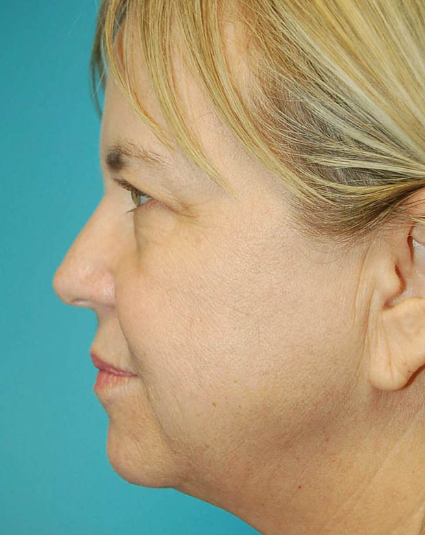 Forehead Lift case #4395