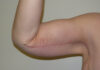 Arm Lift case #3718