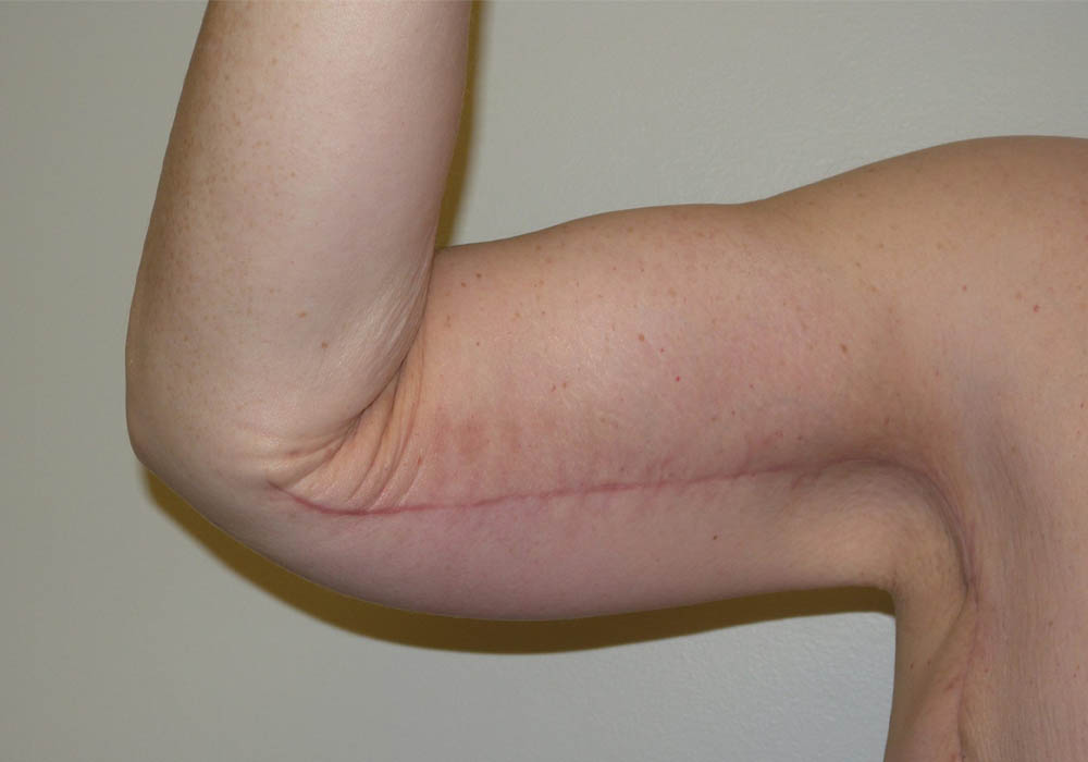 Arm Lift case #3718